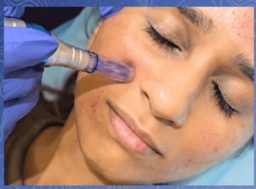 Microneedling skin rejuvenation treatment at Promed Aesthetics